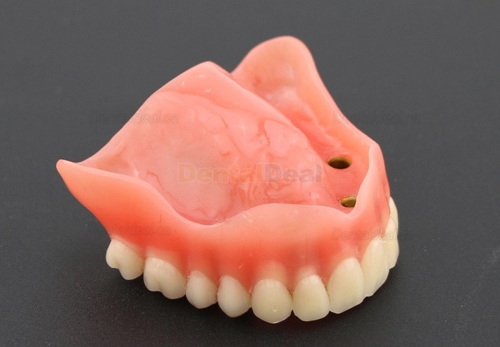 Dental Teeth Implant Overdenture Model Upper Jaw With 4 Implants Study Demo Model 6001